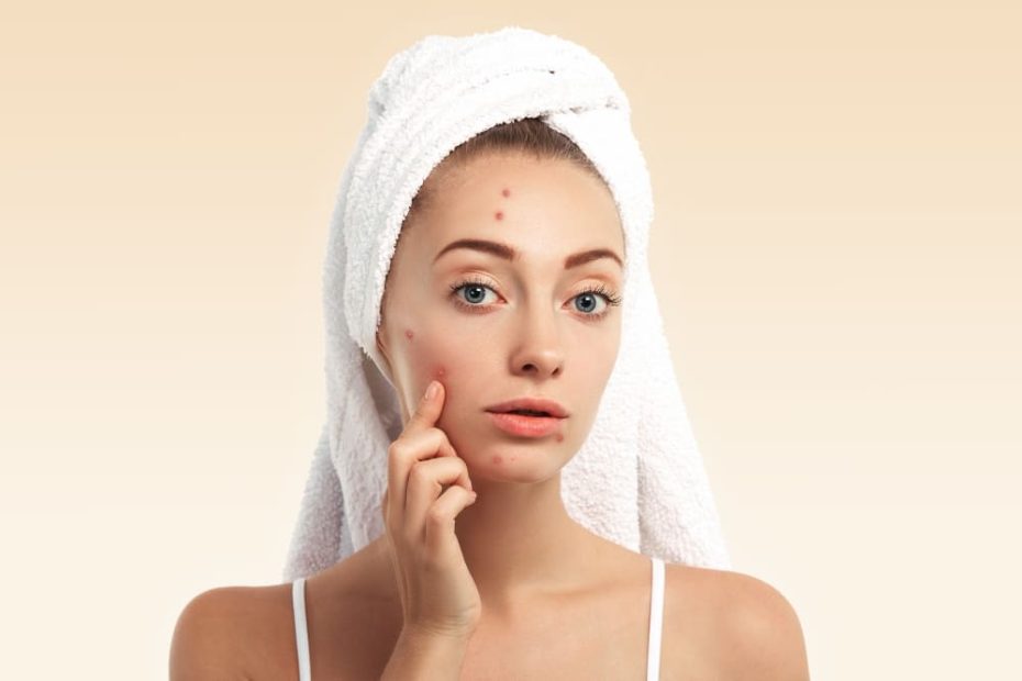 Clear Acne For Good